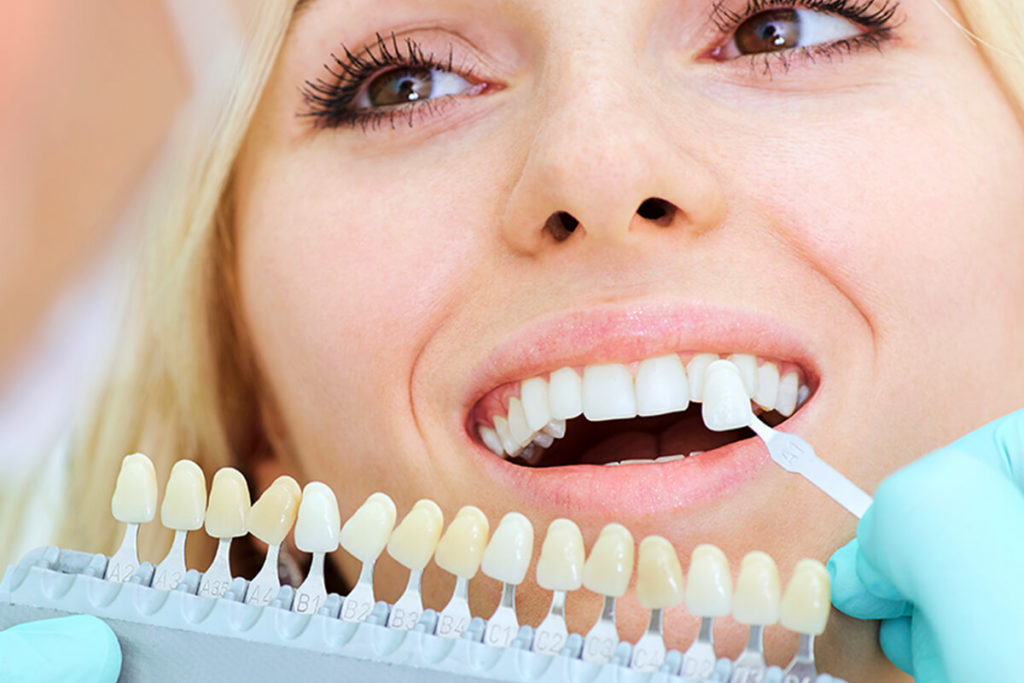 Southern California Family Dentistry - Crowns and Veneers
