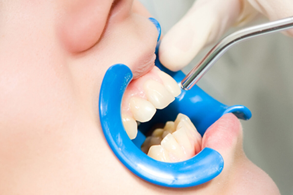 Southern California Family Dentistry - Dental Sealants